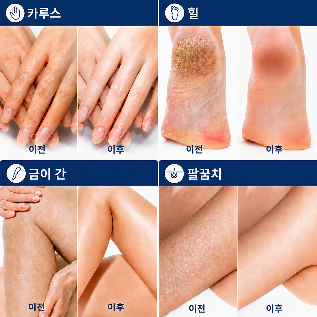 OCESKIN 40% Urea Cream Exfoliating Foot Cream 130g